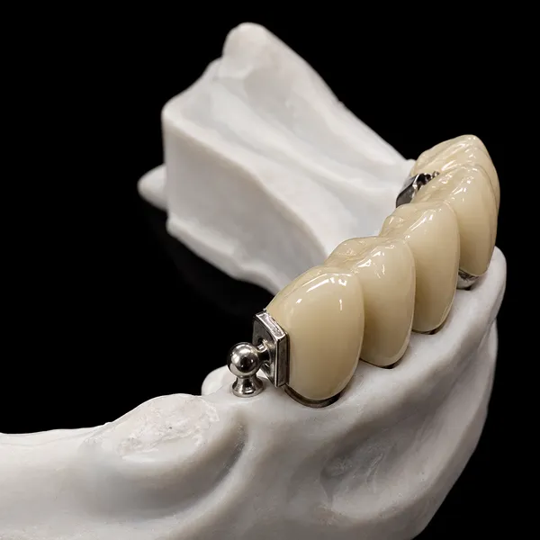PFM Crown with Ball Attachment