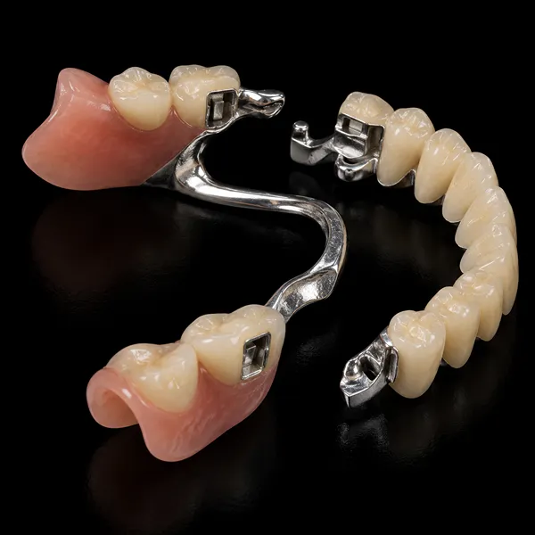 PFM Crown with Intracoronal Attachment