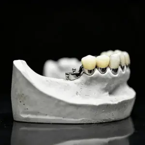 PFM Crown with Precision Attachment