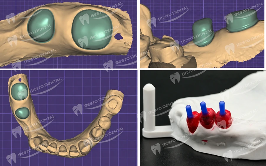 Partial Denture Design