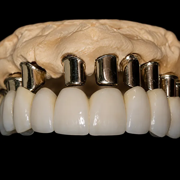 Primary PFM Telescopic Crown