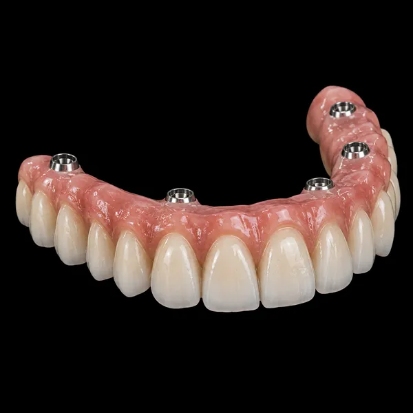 Screw-Retained Full-Arch PFM Bridge01