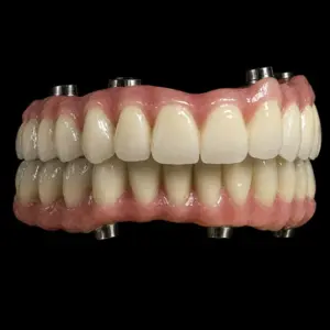 Screw-Retained PFM Implant Bridge