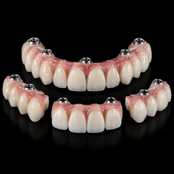 Segmented Full-Arch PFM Implant Bridge