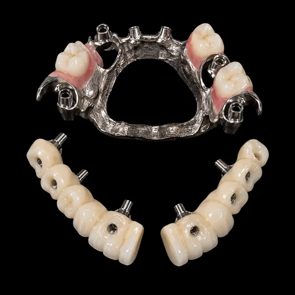 Segmented PFM Implant Bridge