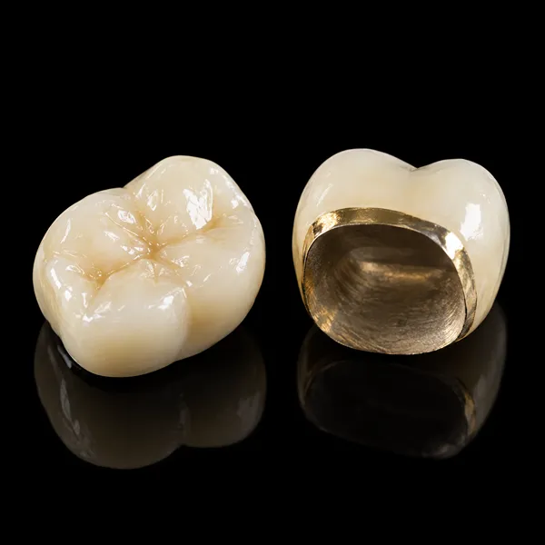 Semi-Precious PFM Crown