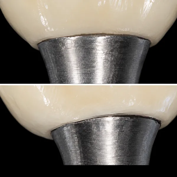 Titanium PFM Crown