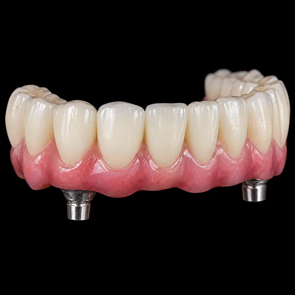 Titanium PFM Implant Bridge
