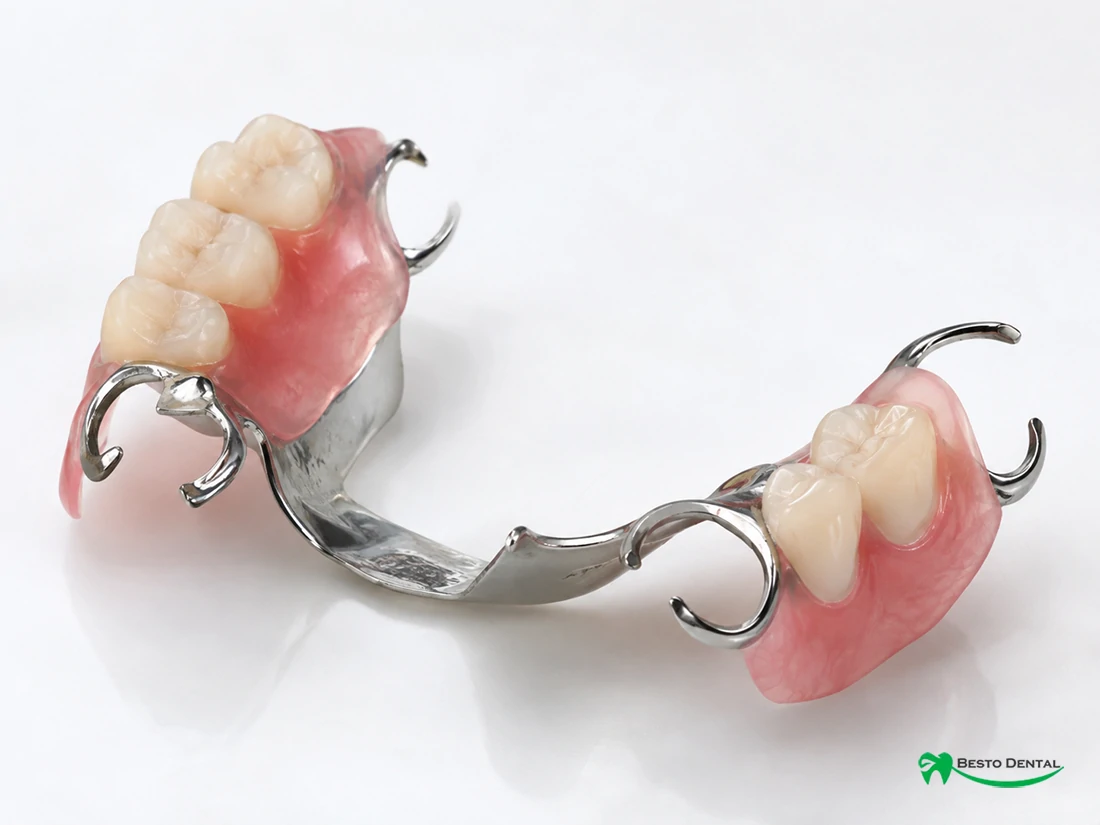 What Are Partial Dentures
