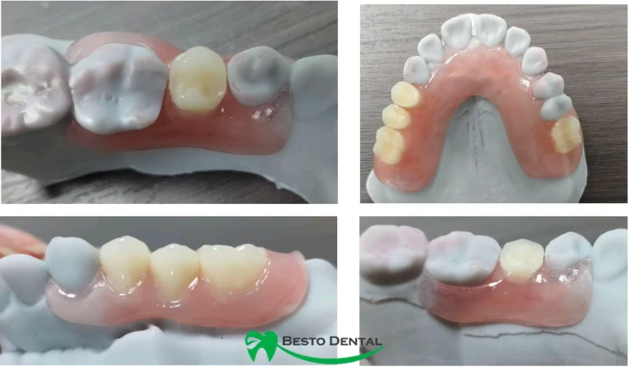 What are Flexible Dentures