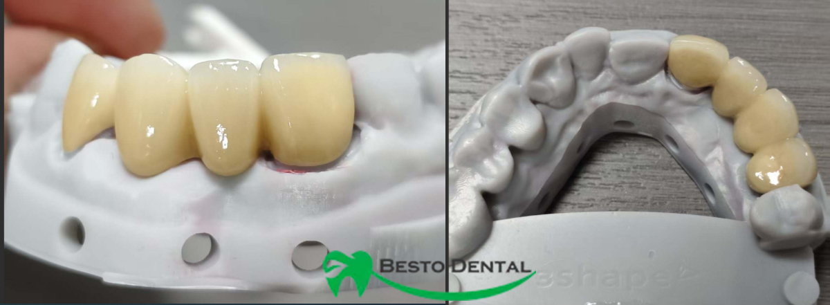 What is a Dental Bridge