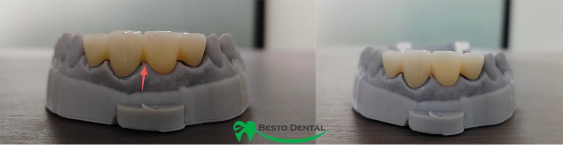 Zirconia Dental Bridges 01