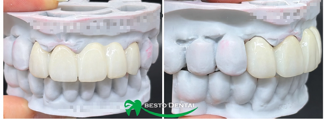 Zirconia Dental Bridges 02