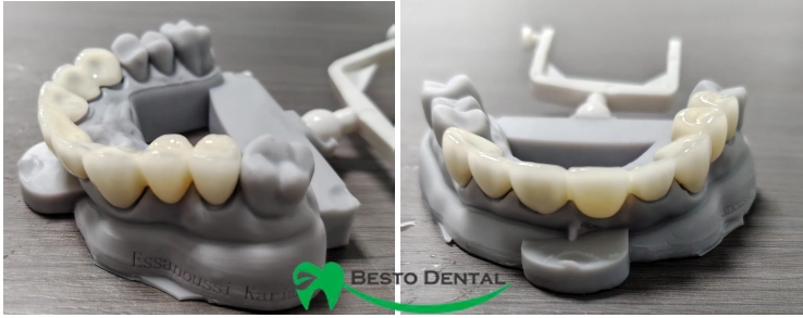 Zirconia Dental Bridges 03