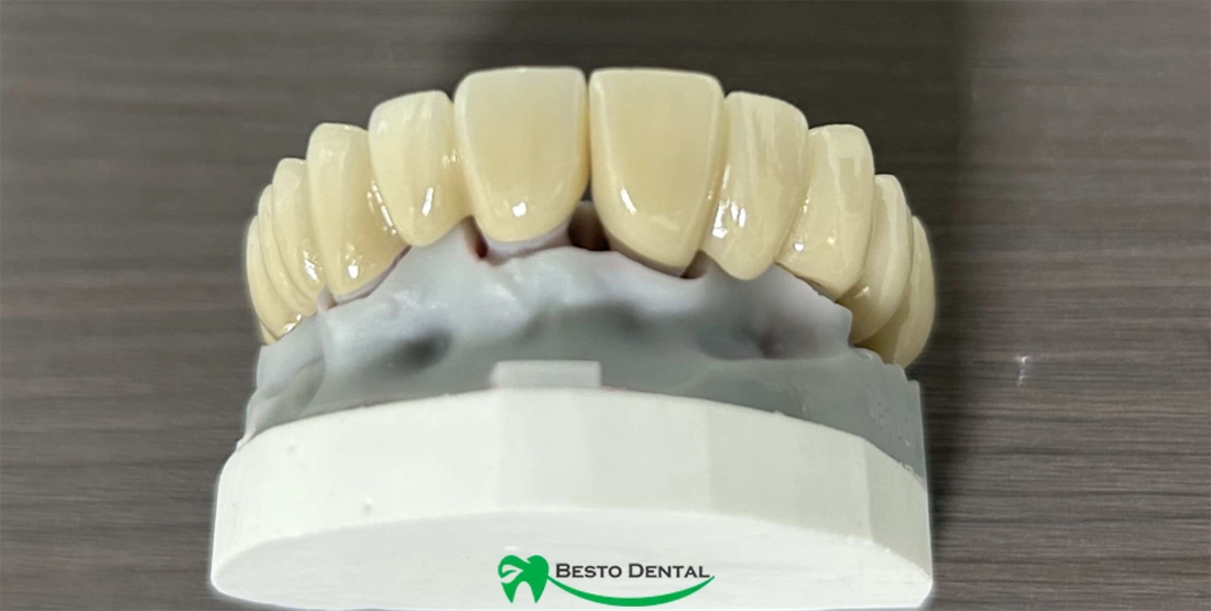 Zirconia Dental Bridges 04