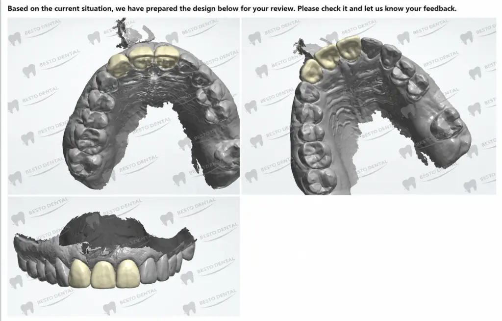 Zirconia Dental Bridges 06