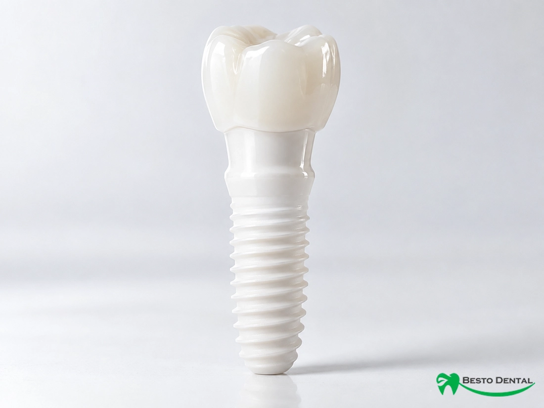 Zirconia Dental Implants 01