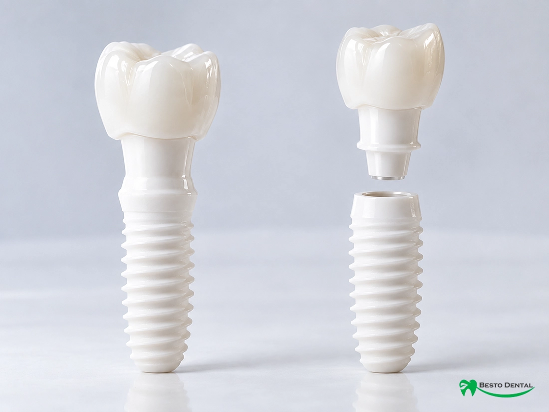 Zirconia Dental Implants 02