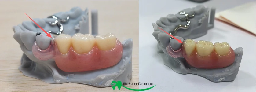 avoid visible metal on the buccal side