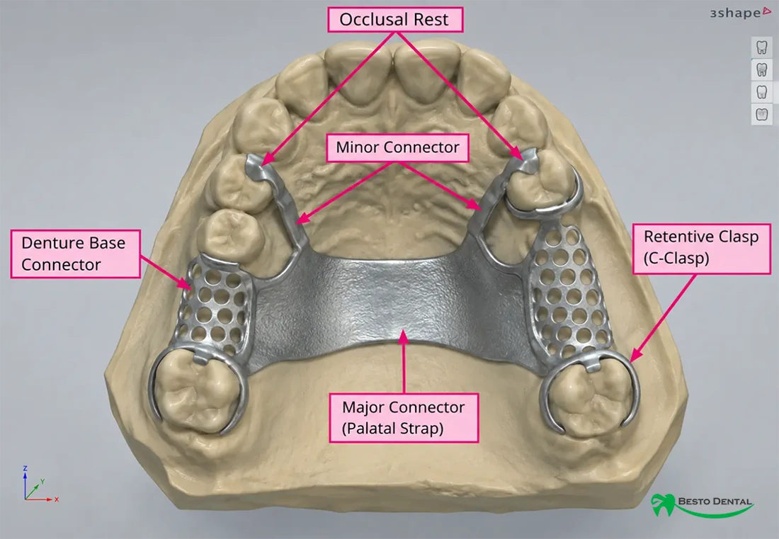 cast partial denture components