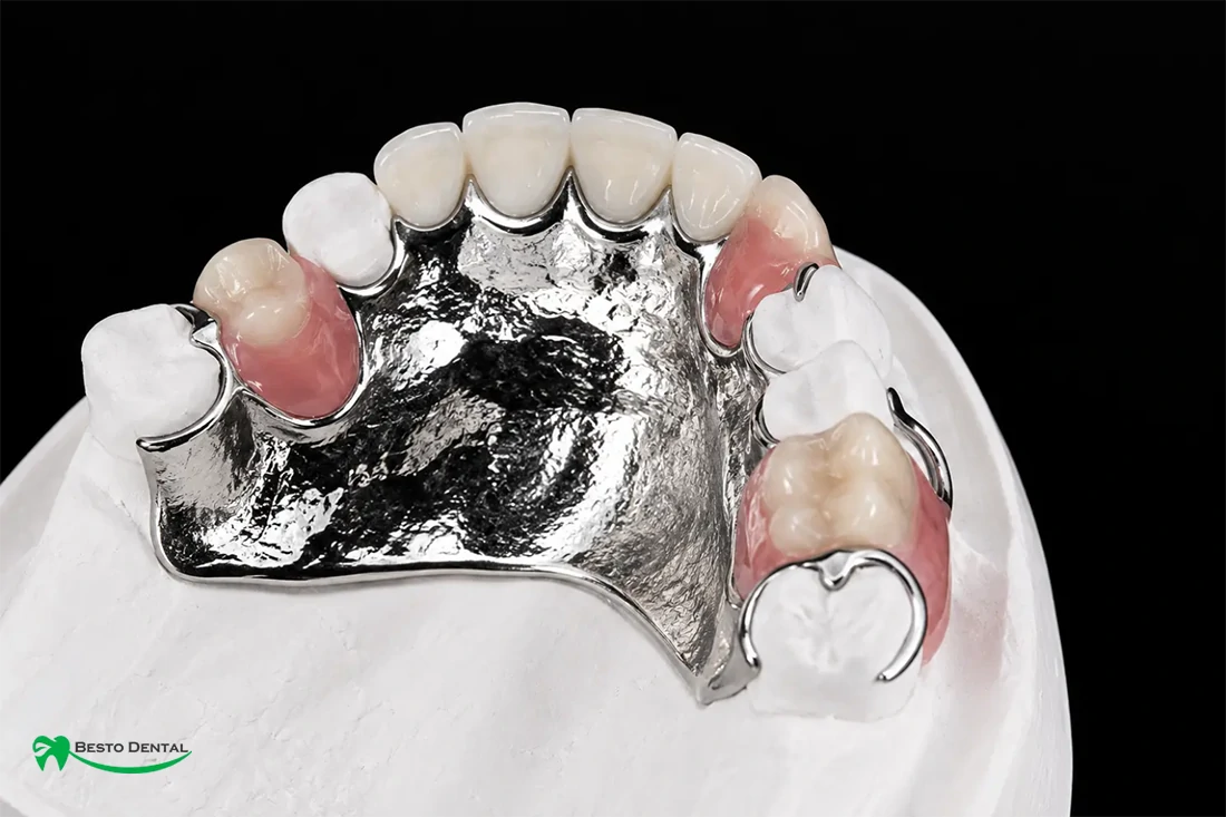 cast partial denture