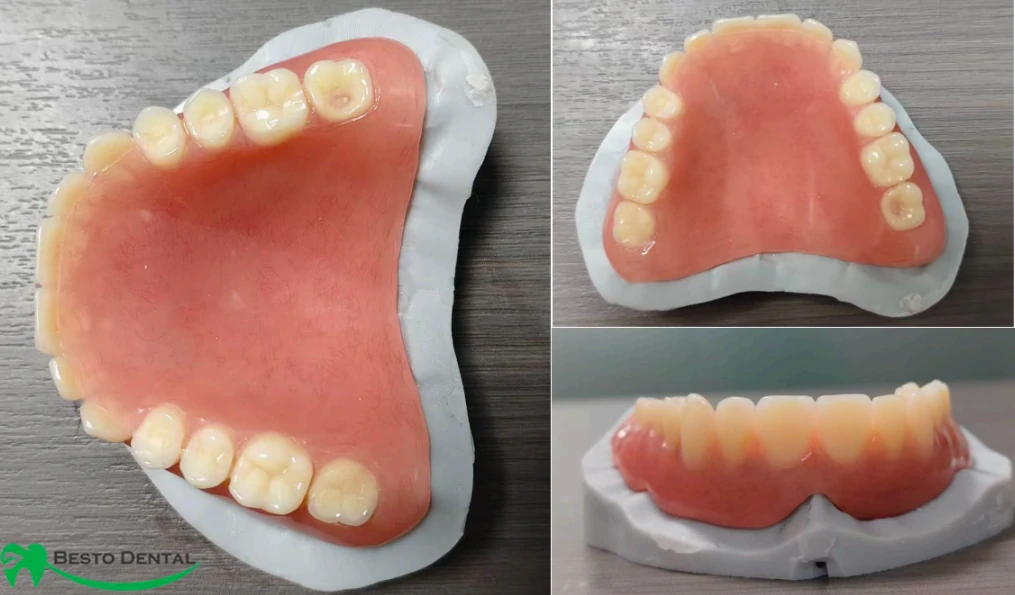 immediate denture
